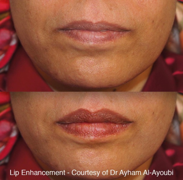 Lip Enhancement - Courtesy of Dr Ayham Al-Ayoubi